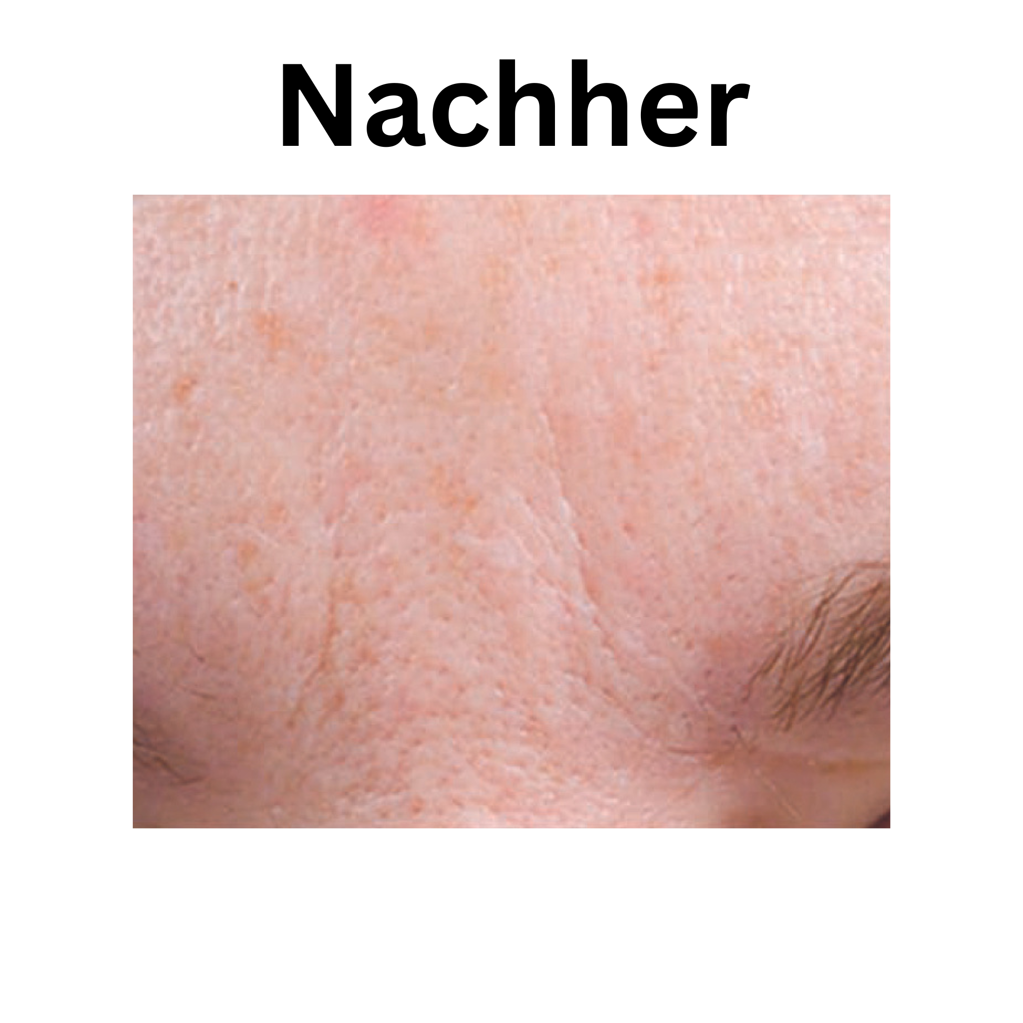 iS Clinical Vorher Nachher Bilder iS Clinical Active Serum Vorher Nachher Bilder