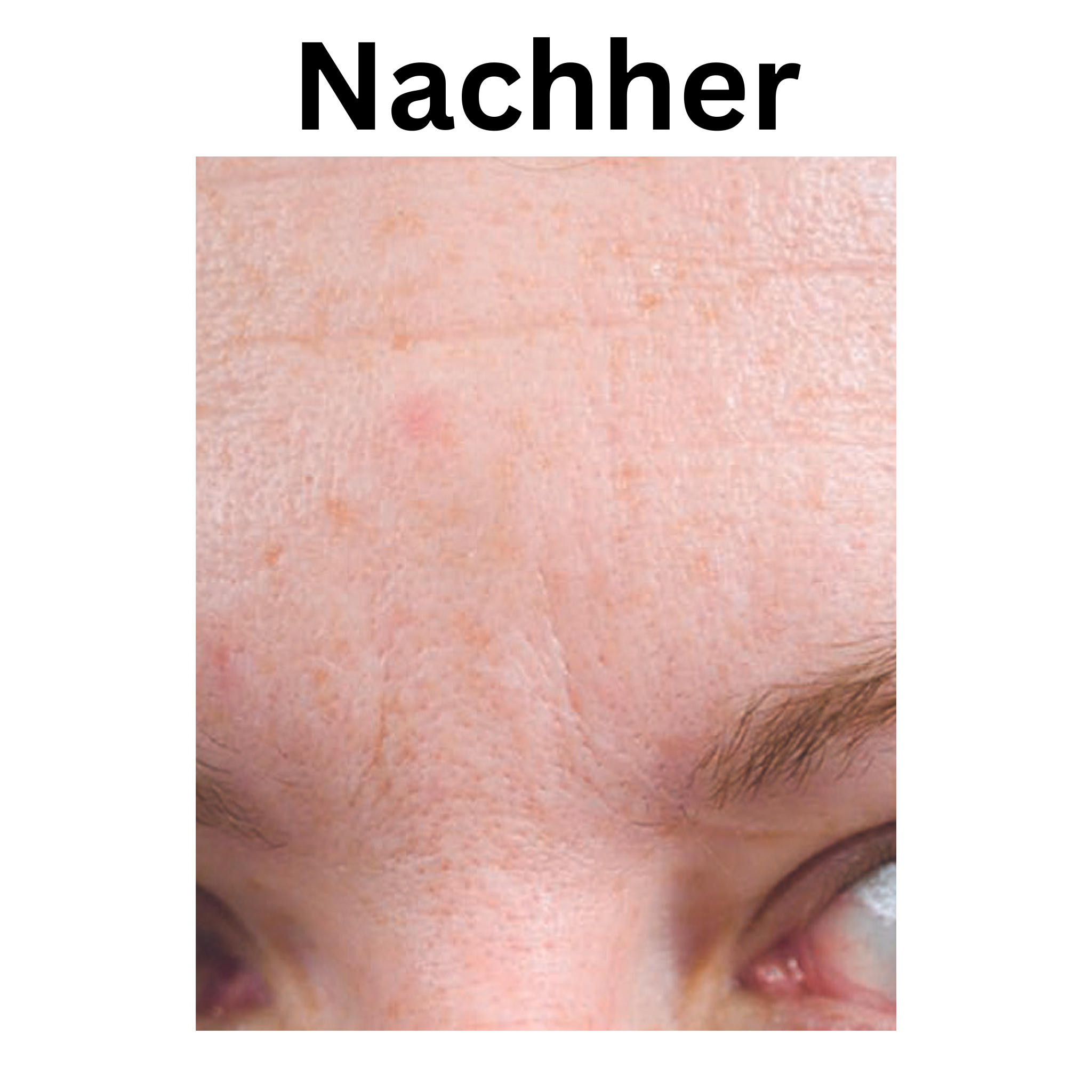is clinical vorher nachher bilder pigmentflecken active serum vorher nachher bilder