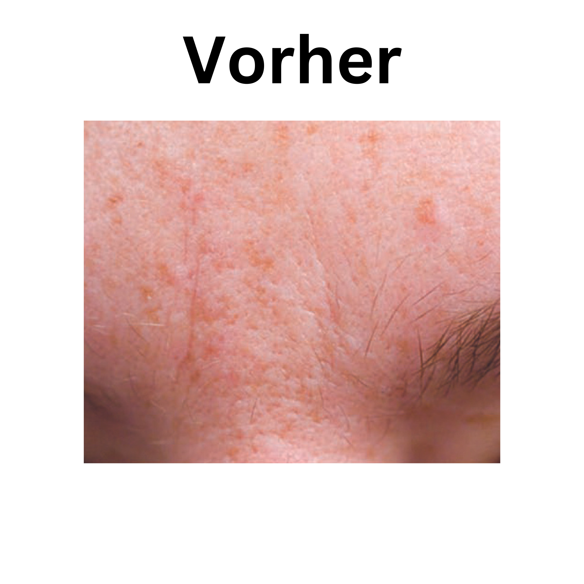 iS Clinical Vorher Nachher Bilder iS Clinical Active Serum Vorher Nachher Bilder